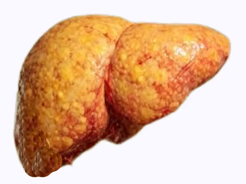 An isolated anatomical illustration of a human liver showing signs of fatty liver disease accumulation on a clean white background.